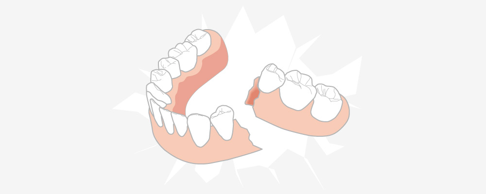 豊田歯科クリニックの入れ歯が壊れた場合の対処法解説
