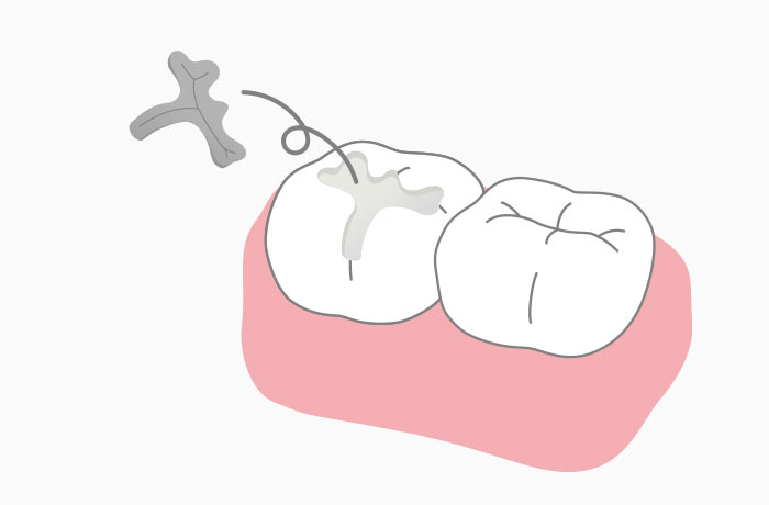 豊田歯科クリニック | 詰め物が外れてしまう理由と注意点