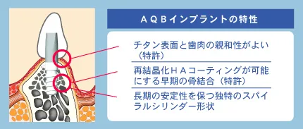 豊田歯科クリニック | AQBインプラント