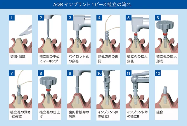 豊田歯科クリニック | AQBインプラント