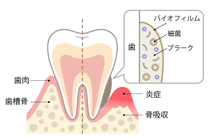 豊田歯科クリニック | 細菌とウイルスの違いと感染症予防