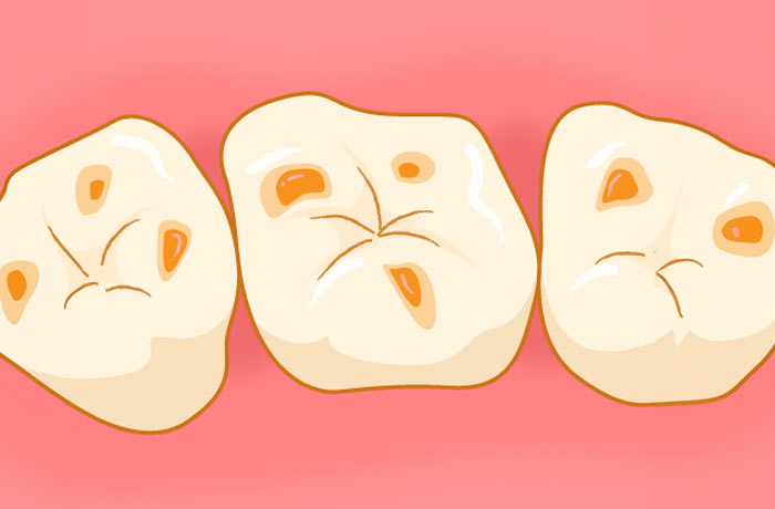 3月４日は「酸蝕歯の日」です！