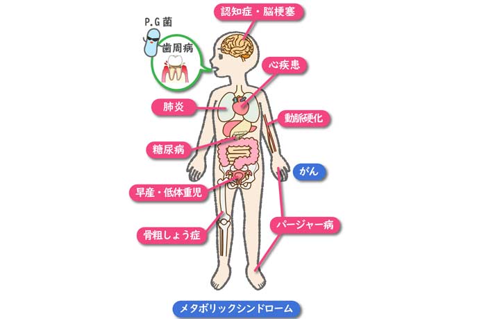 とても大切な「お口の健康」 歯周病が全身に及ぼす影響。糖尿病、心疾患、脳梗塞、認知症などとの関連性を示す解説図