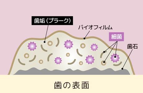 インフルエンザシーズンがやってきました 歯の表面に付着した歯垢(プラーク)・バイオフィルム・細菌・歯石の位置関係を示す断面図